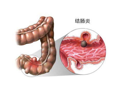 图示：结肠炎