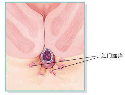 肛门瘙痒是怎么回事？