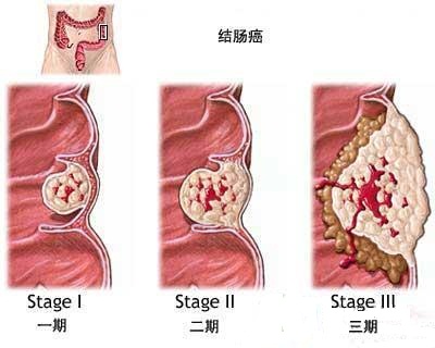 结肠炎发生恶变的因素有哪些？