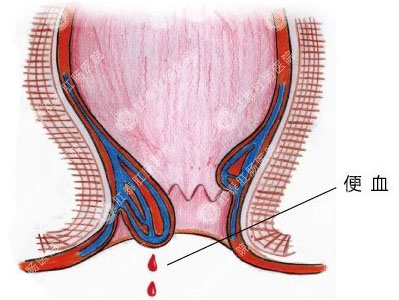 肛裂便血怎么办？