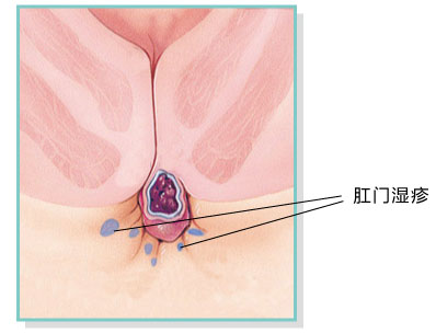 肛门湿疹该如何进行预防？