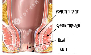 肛裂日常怎么预防？