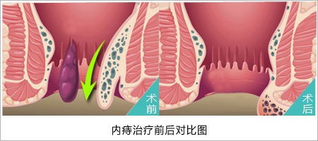 痔疮的治疗方法到医博医院!