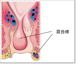 痔疮的治疗方法医博医院值得信赖!