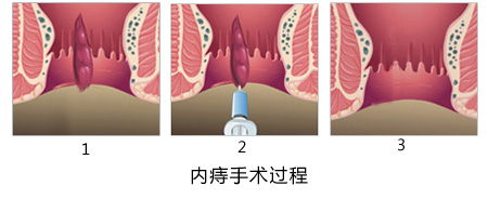 痔疮的治疗方法医博医院!