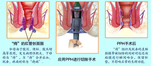 痔疮怎么治疗到医博医院!